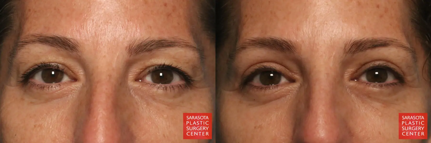 Eyelid Surgery: Patient 23 - Before and After  