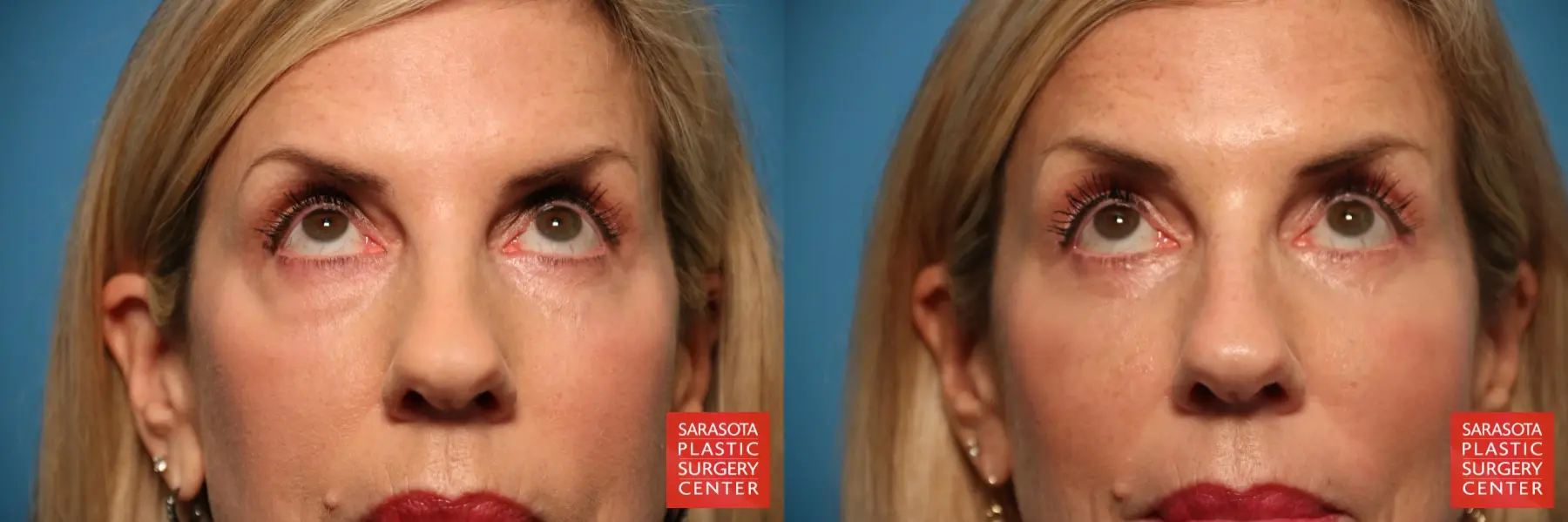 Eyelid Surgery: Patient 10 - Before and After 4