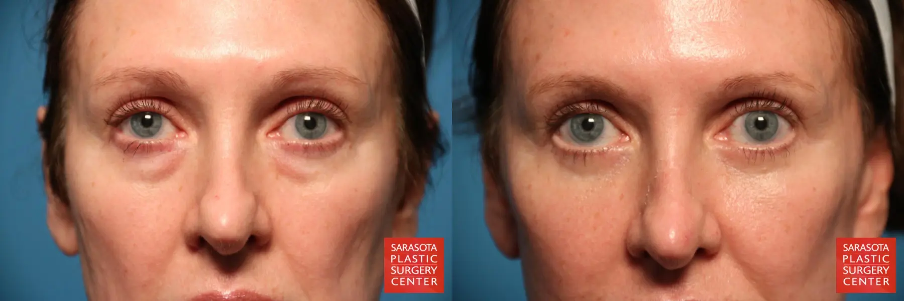 Eyelid Surgery: Patient 15 - Before and After  