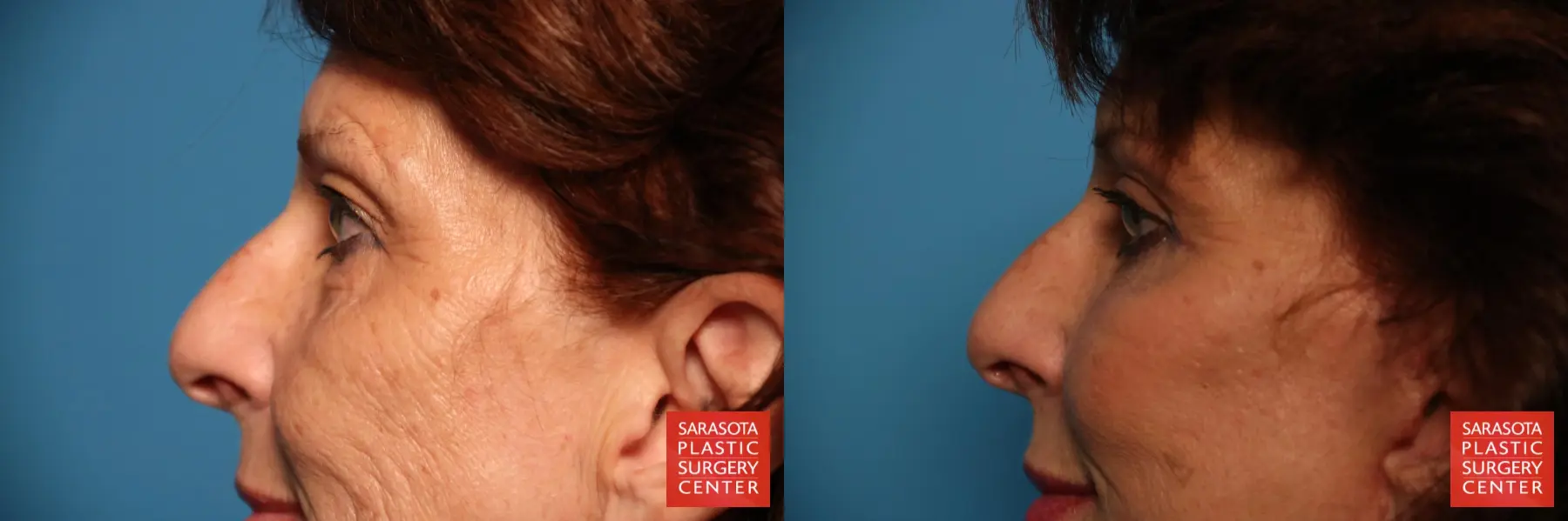 Eyelid Surgery: Patient 25 - Before and After 5