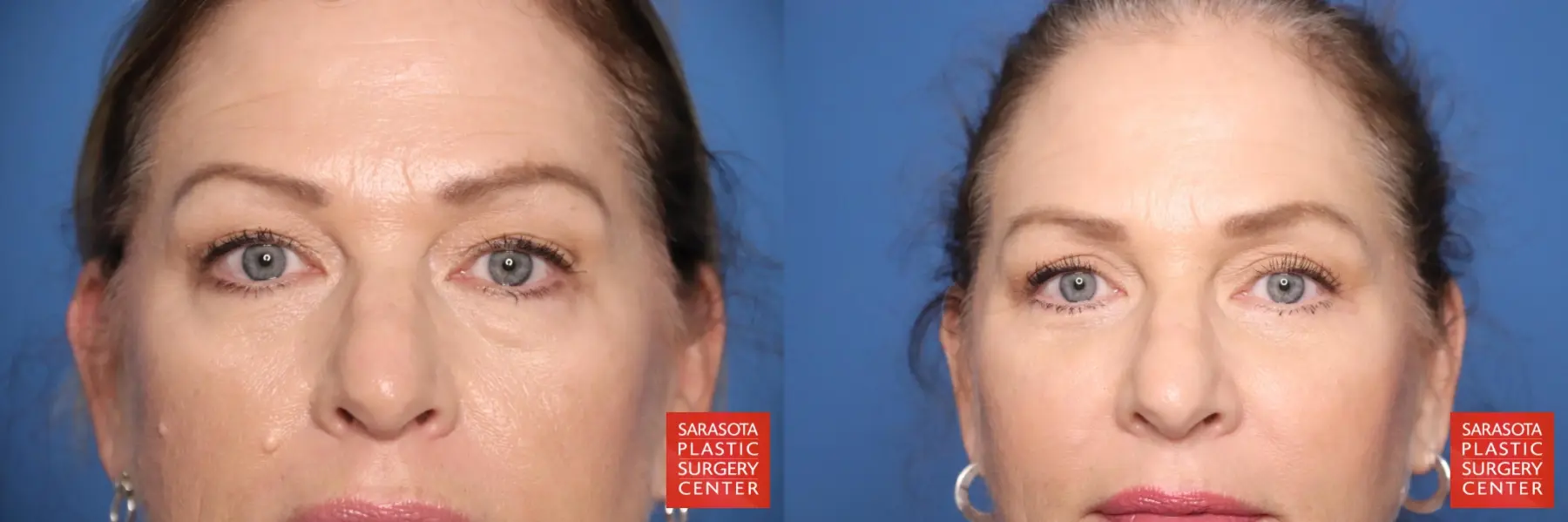 Eyelid Surgery: Patient 39 - Before and After  