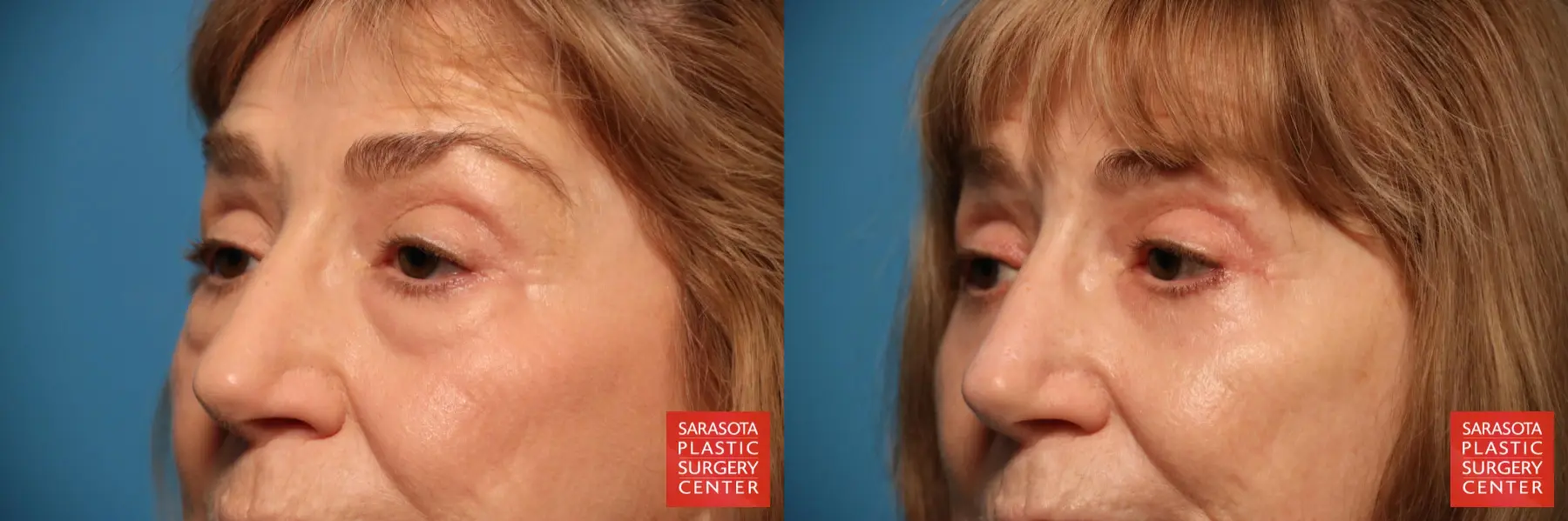 Eyelid Surgery: Patient 24 - Before and After 4