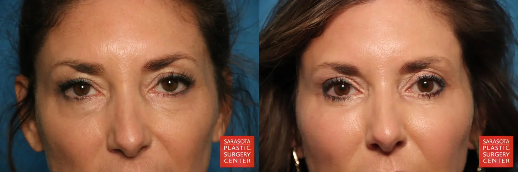 Eyelid Surgery: Patient 6 - Before and After  