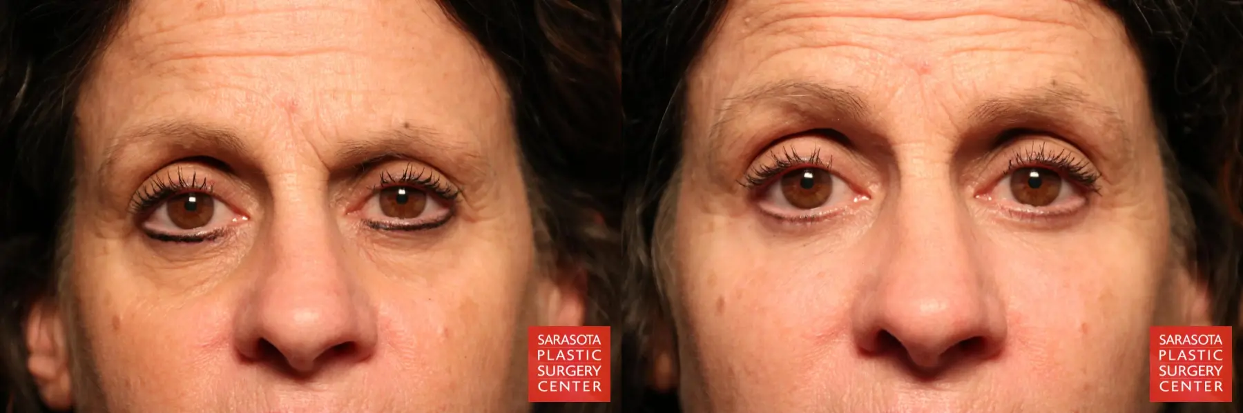 Eyelid Surgery: Patient 36 - Before and After  