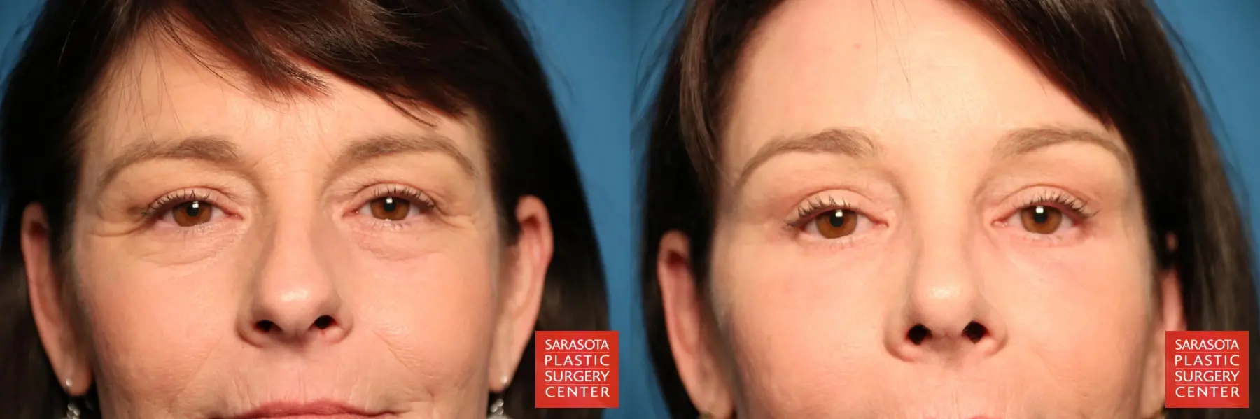 Eyelid Surgery: Patient 8 - Before and After  