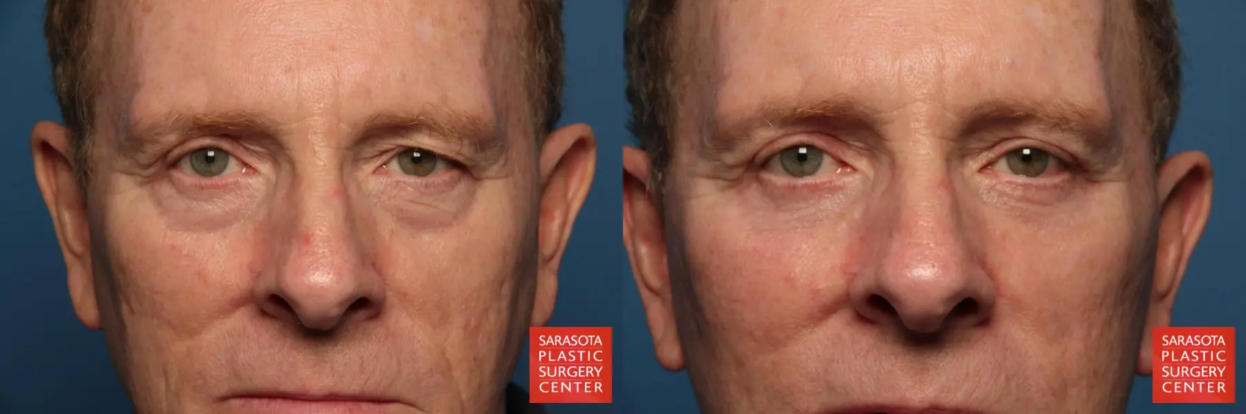 Eyelid Surgery: Patient 27 - Before and After  