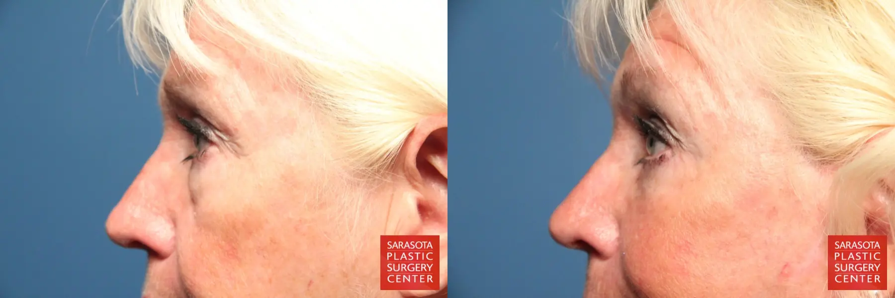 Eyelid Surgery: Patient 1 - Before and After 5