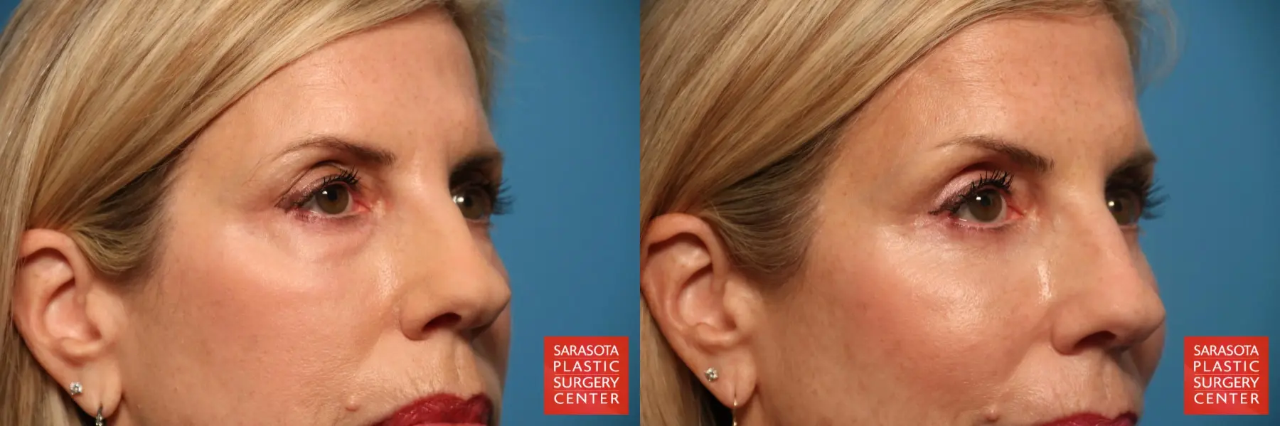 Eyelid Surgery: Patient 10 - Before and After 2