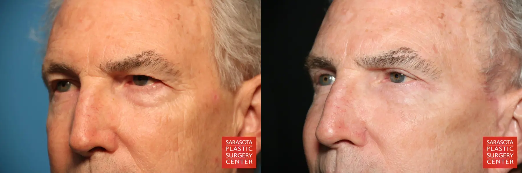 Eyelid Surgery: Patient 7 - Before and After 4