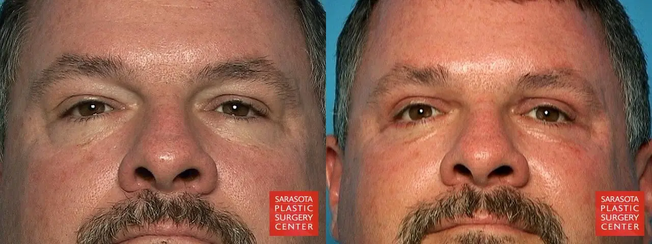 Eyelid Surgery: Patient 9 - Before and After  