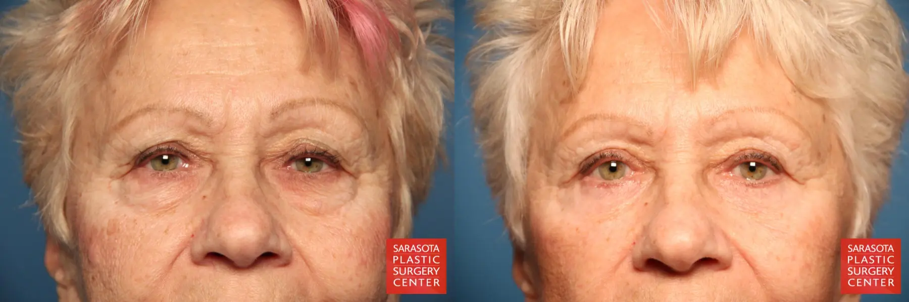 Eyelid Surgery: Patient 29 - Before and After  