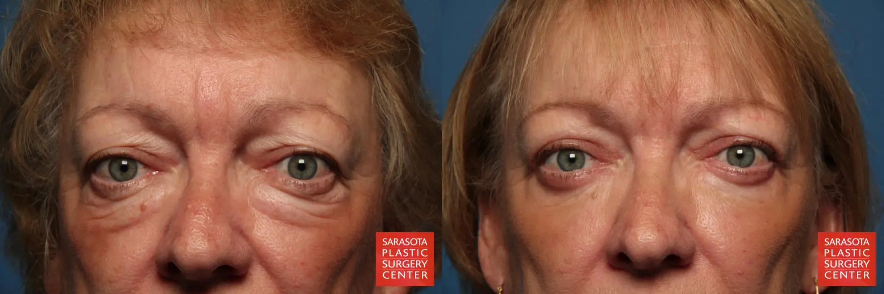 Eyelid Surgery: Patient 37 - Before and After  