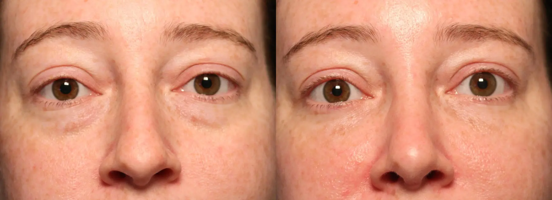 Eyelid Surgery: Patient 14 - Before and After  