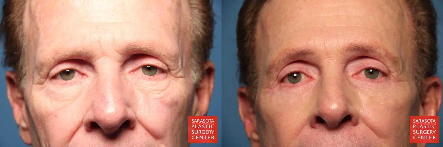 Eyelid Surgery: Patient 13 - Before and After  