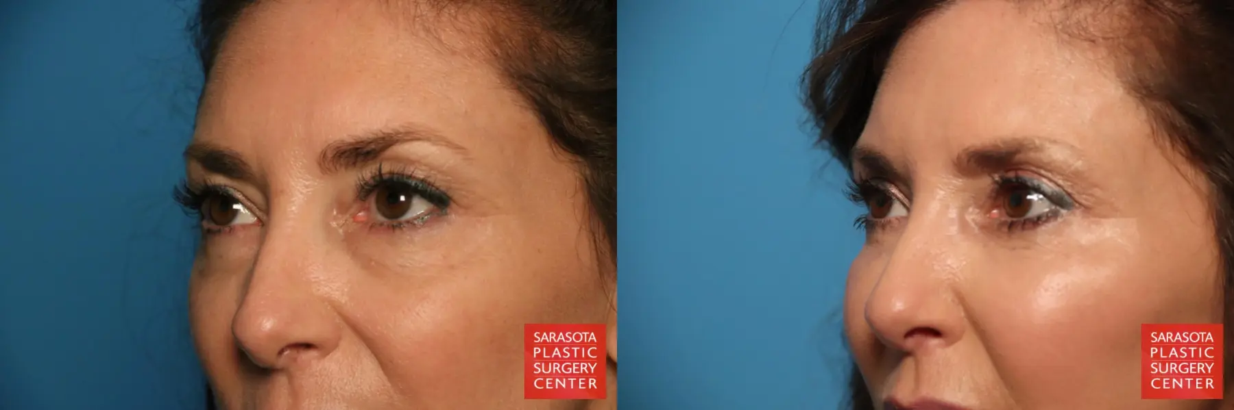 Eyelid Surgery: Patient 6 - Before and After 4