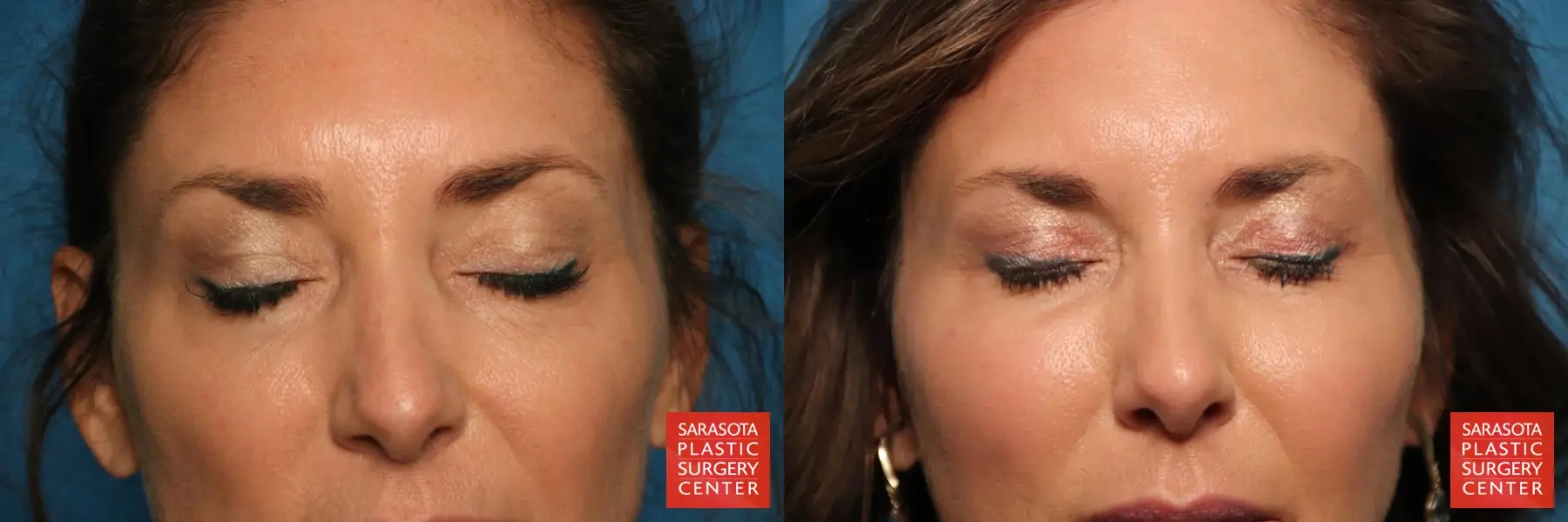 Eyelid Surgery: Patient 6 - Before and After 3