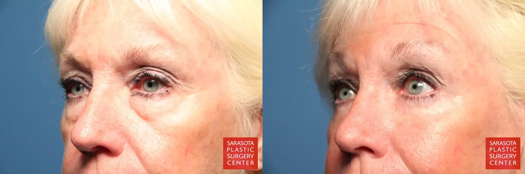 Eyelid Surgery: Patient 1 - Before and After 4