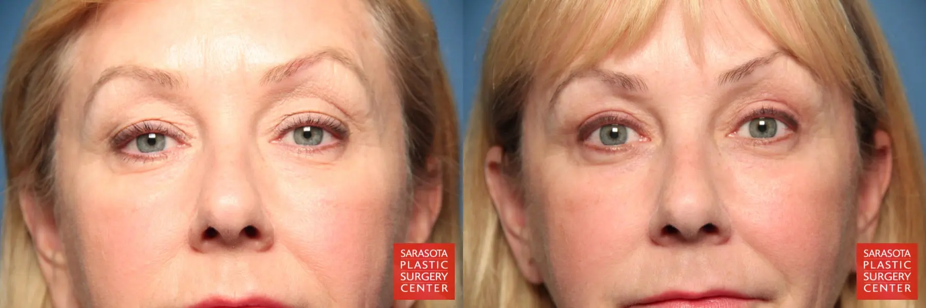 Eyelid Surgery: Patient 26 - Before and After  