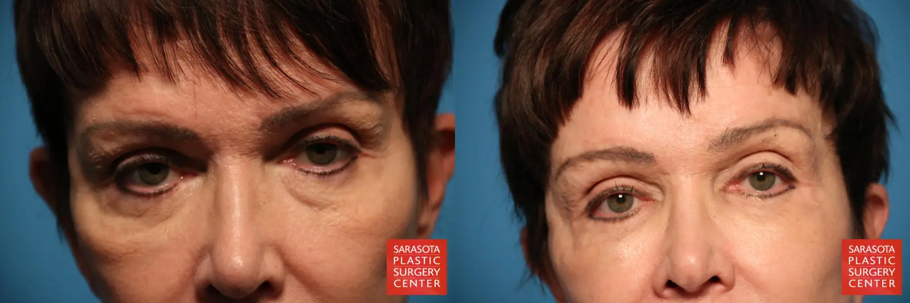 Eyelid Surgery: Patient 30 - Before and After  
