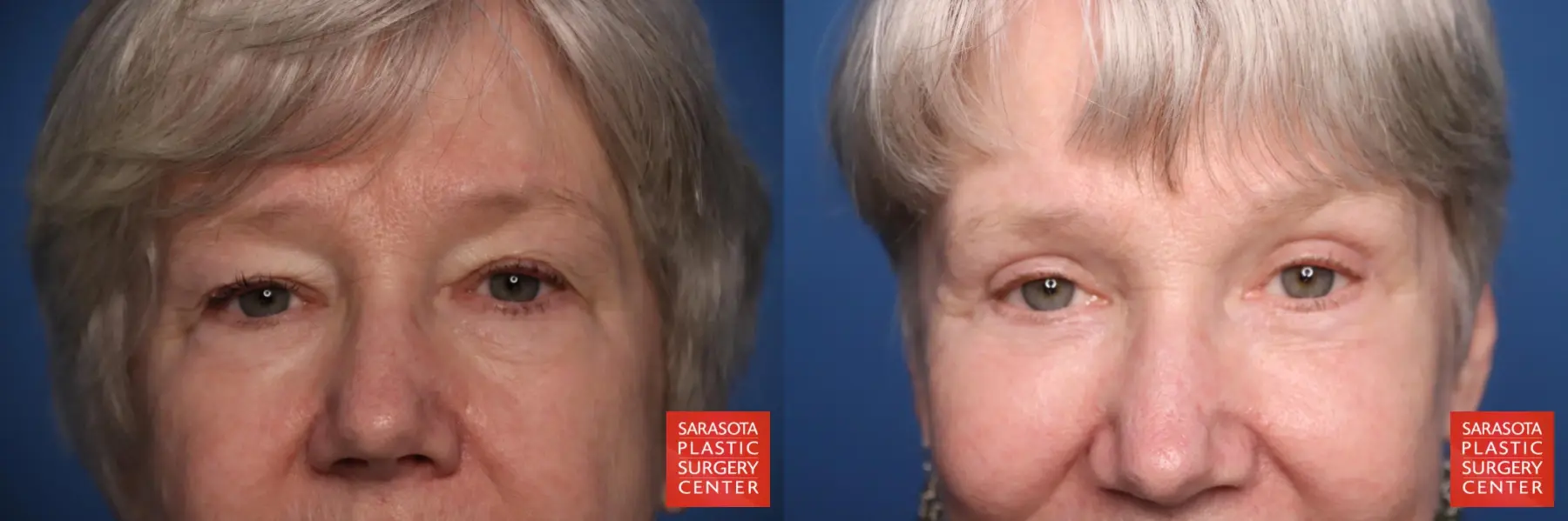 Eyelid Surgery: Patient 33 - Before and After  