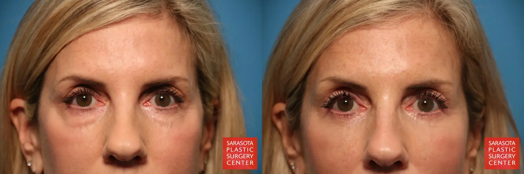 Eyelid Surgery: Patient 10 - Before and After 1