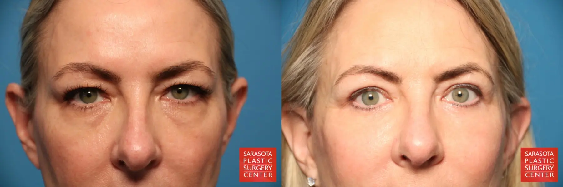 Eyelid Surgery: Patient 2 - Before and After  