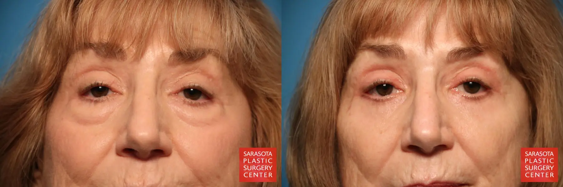 Eyelid Surgery: Patient 24 - Before and After  