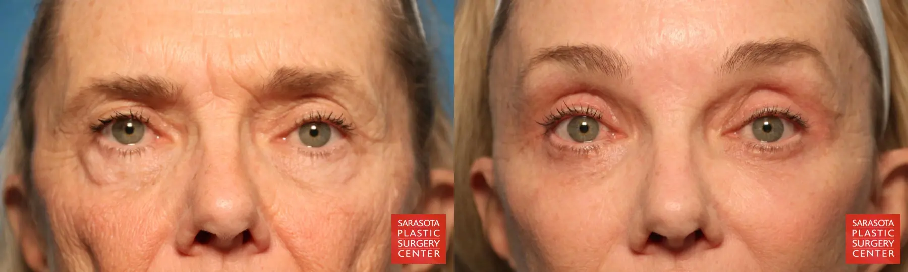 Eyelid Surgery: Patient 17 - Before and After  