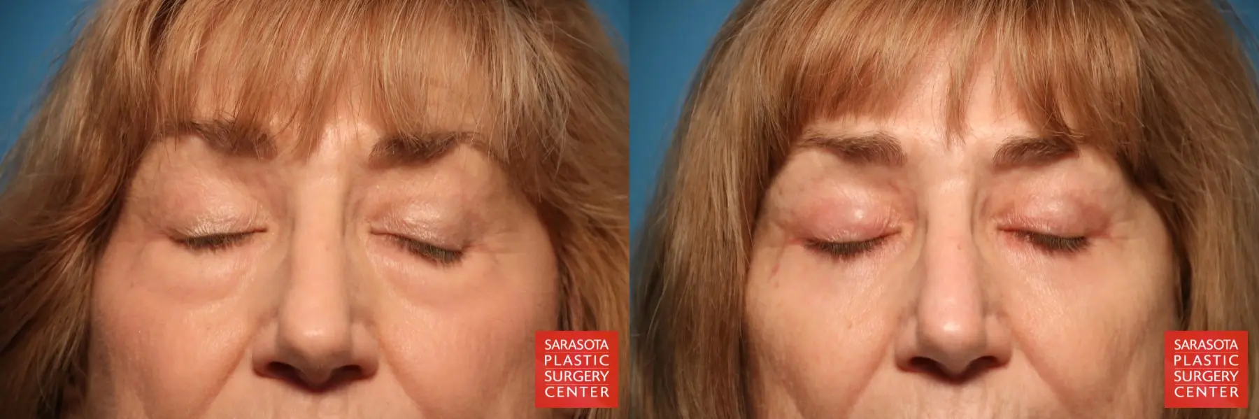 Eyelid Surgery: Patient 24 - Before and After 2
