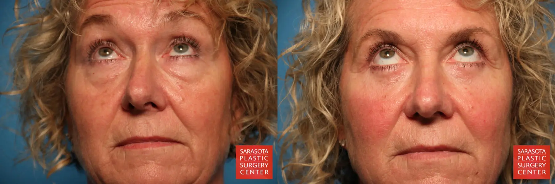 Eyelid Surgery: Patient 4 - Before and After 2