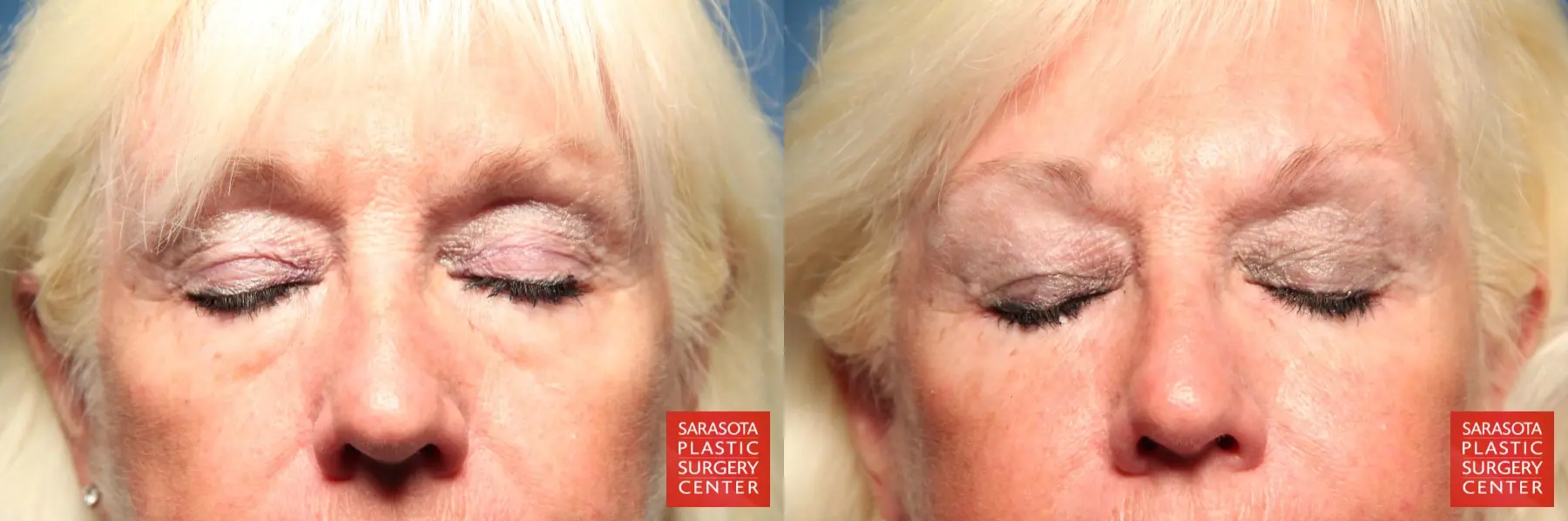 Eyelid Surgery: Patient 1 - Before and After 2
