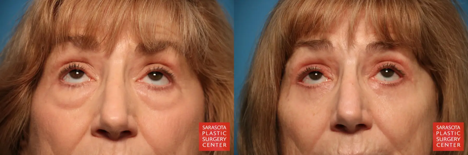 Eyelid Surgery: Patient 24 - Before and After 3