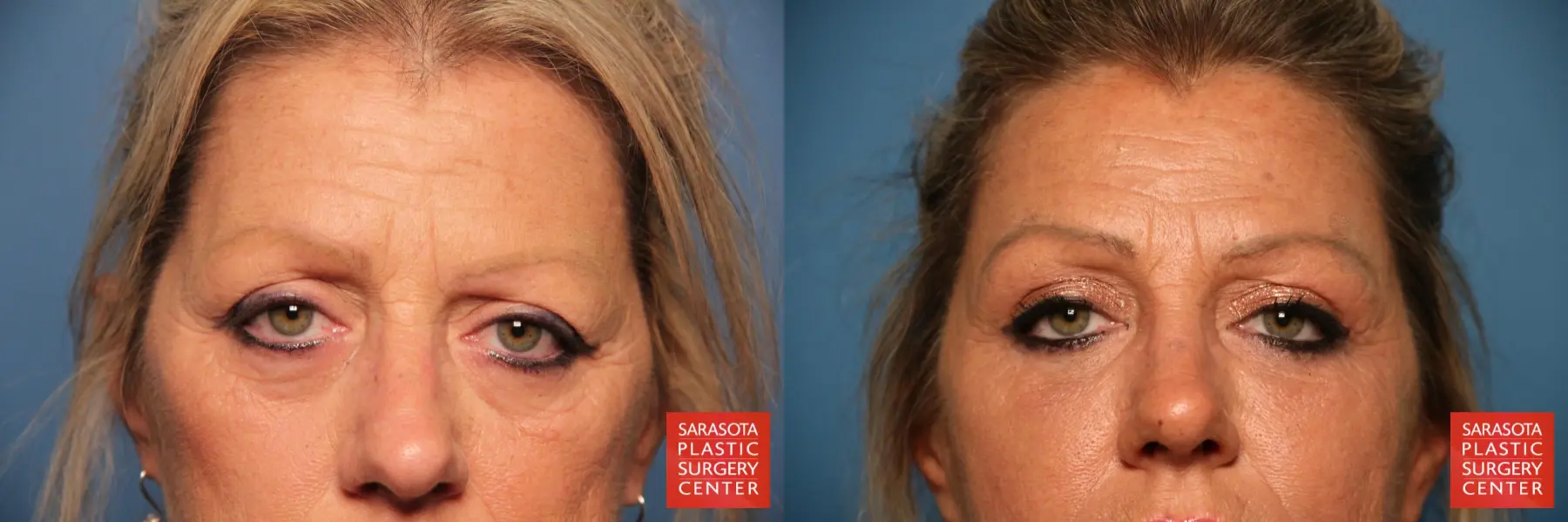Eyelid Surgery: Patient 28 - Before and After  
