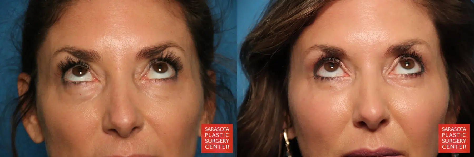 Eyelid Surgery: Patient 6 - Before and After 2