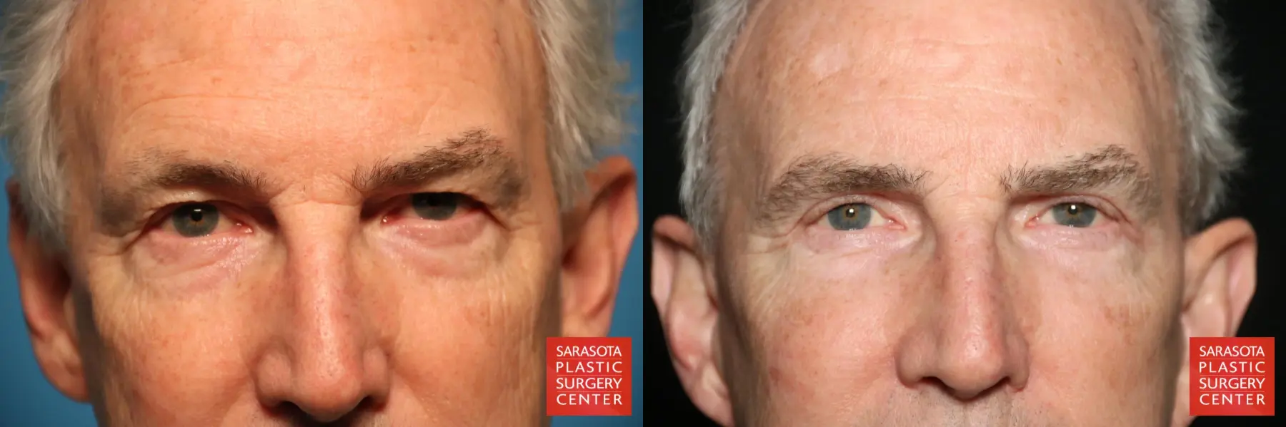 Eyelid Surgery: Patient 7 - Before and After  