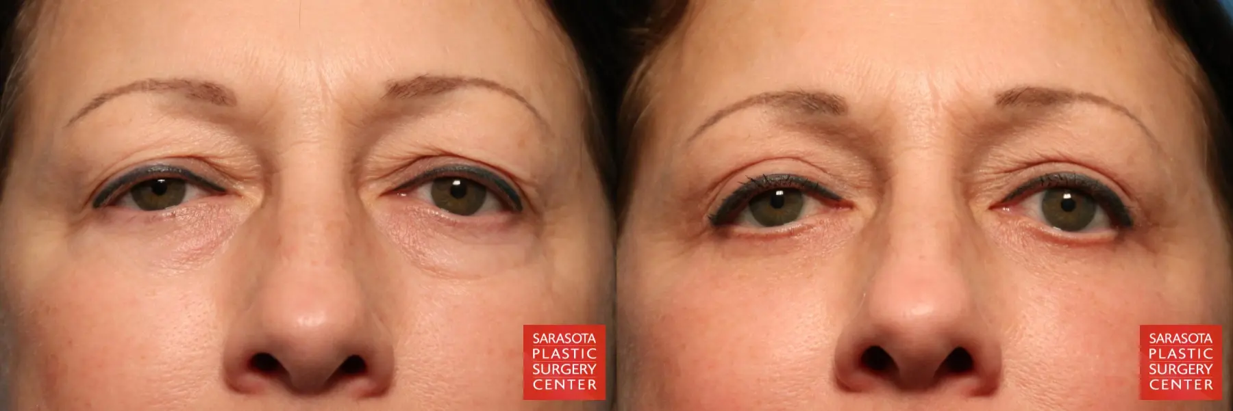Eyelid Surgery: Patient 32 - Before and After  