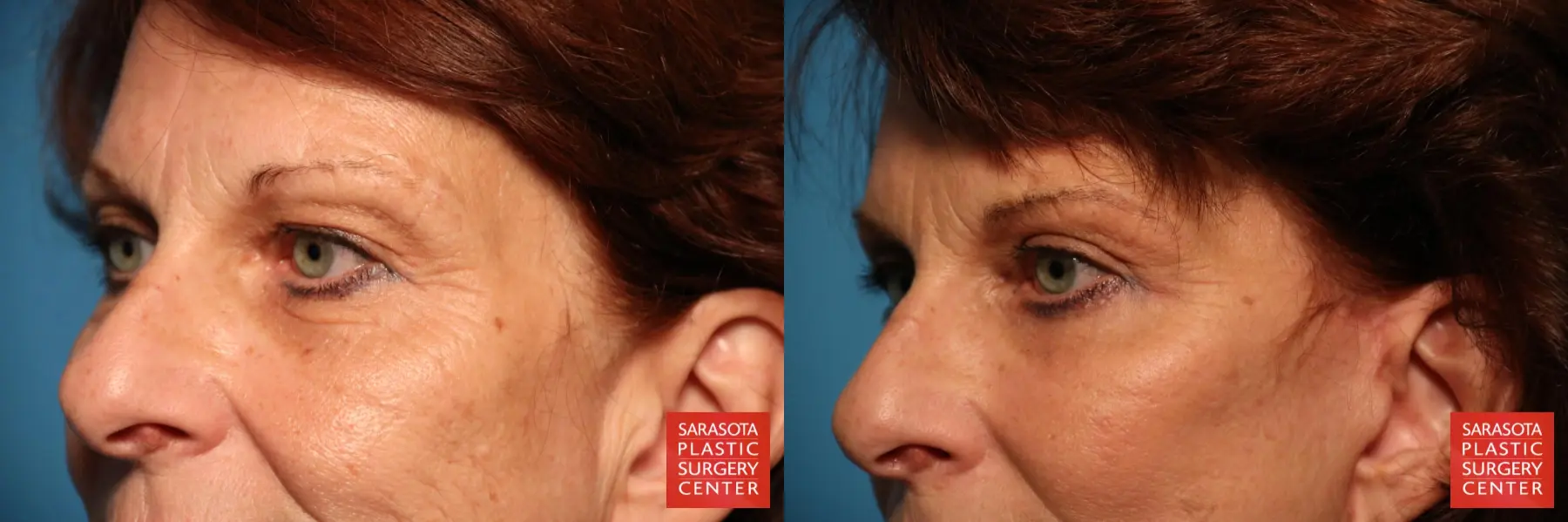 Eyelid Surgery: Patient 25 - Before and After 4