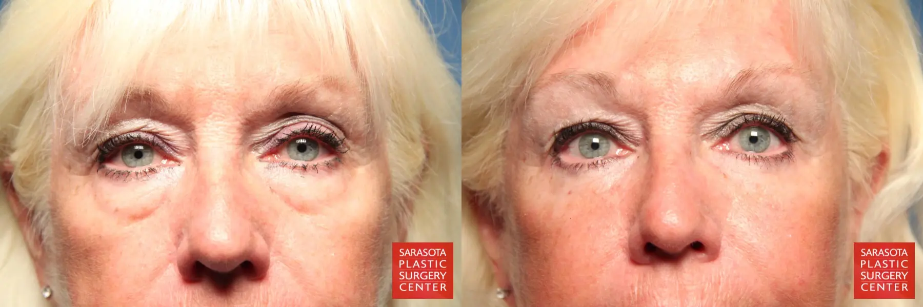 Eyelid Surgery: Patient 1 - Before and After 1