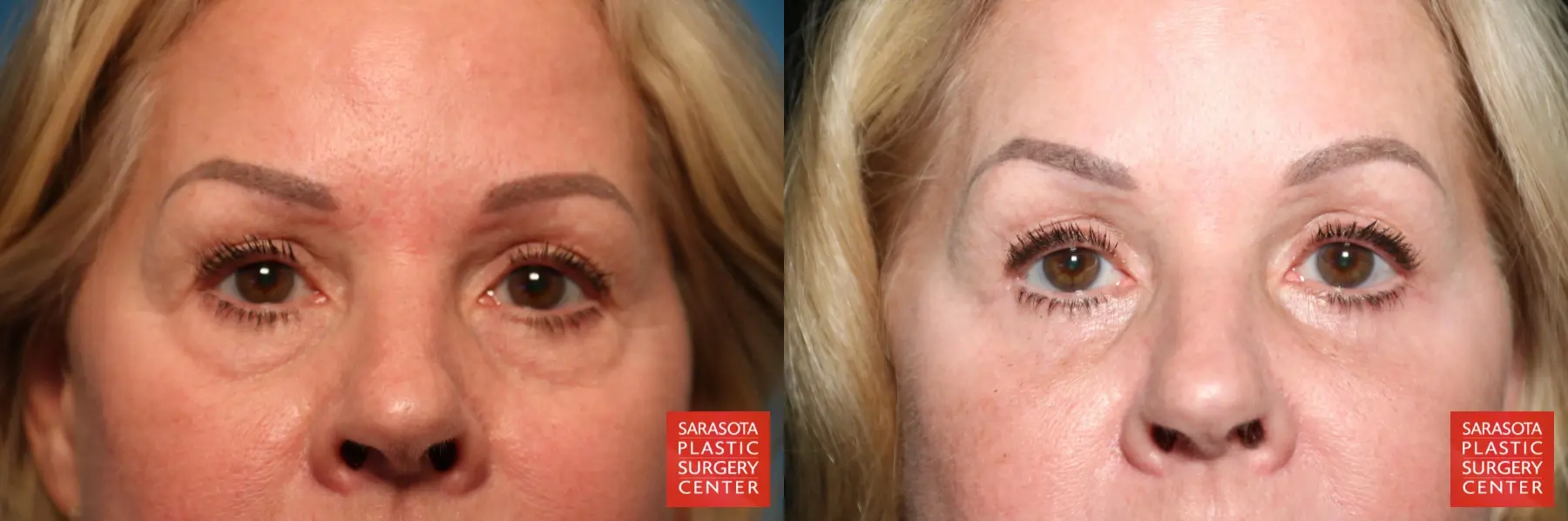 Eyelid Surgery: Patient 11 - Before and After  