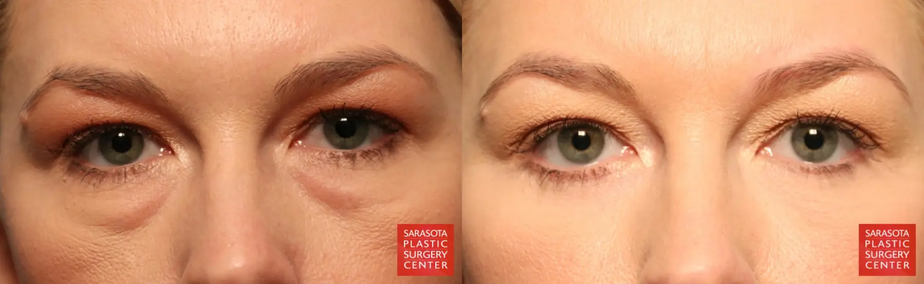 Eyelid Surgery: Patient 5 - Before and After  