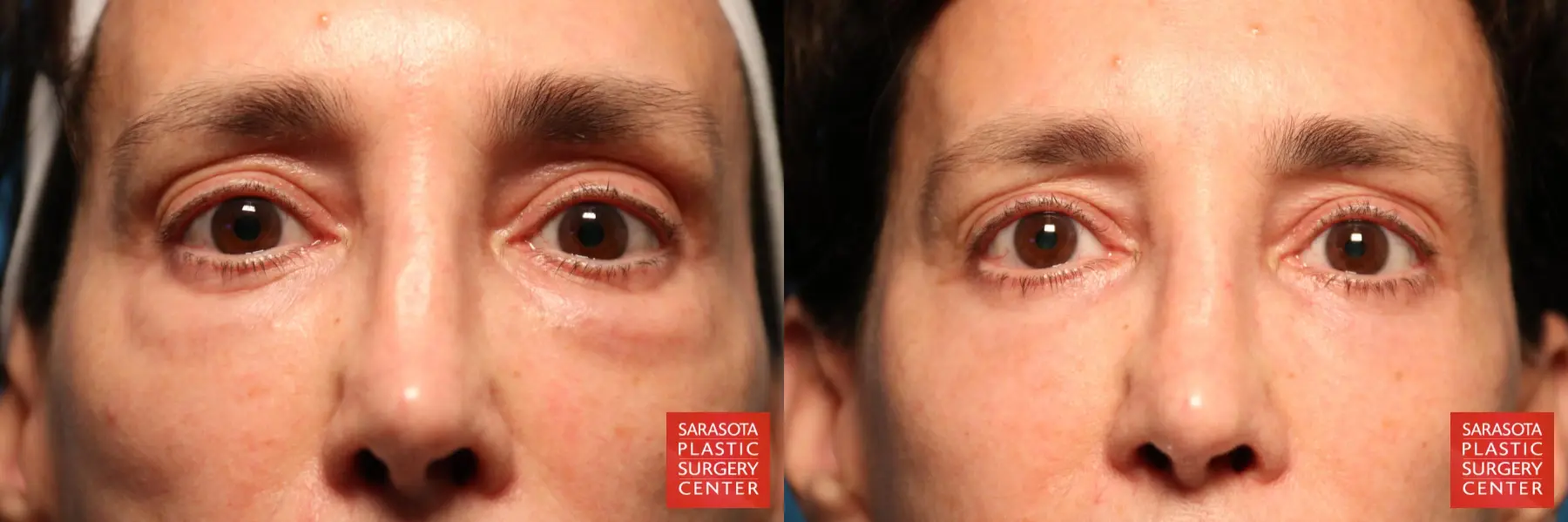 Eyelid Surgery: Patient 20 - Before and After  