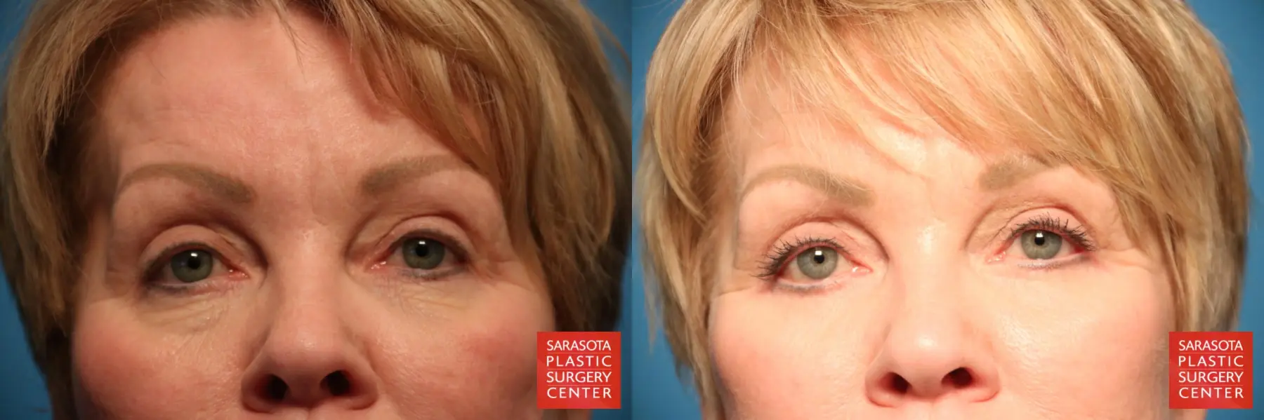 Eyelid Surgery: Patient 38 - Before and After  