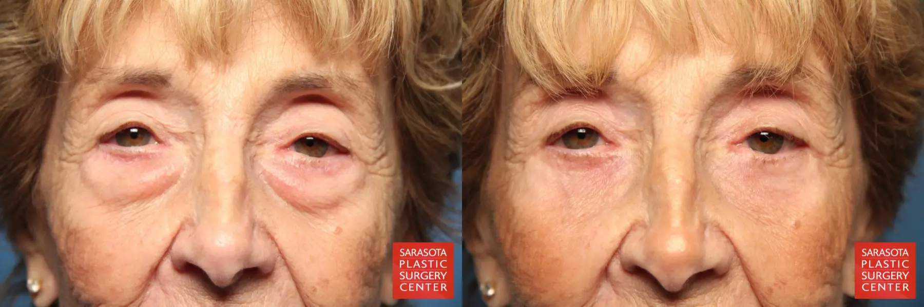 Eyelid Surgery: Patient 12 - Before and After  