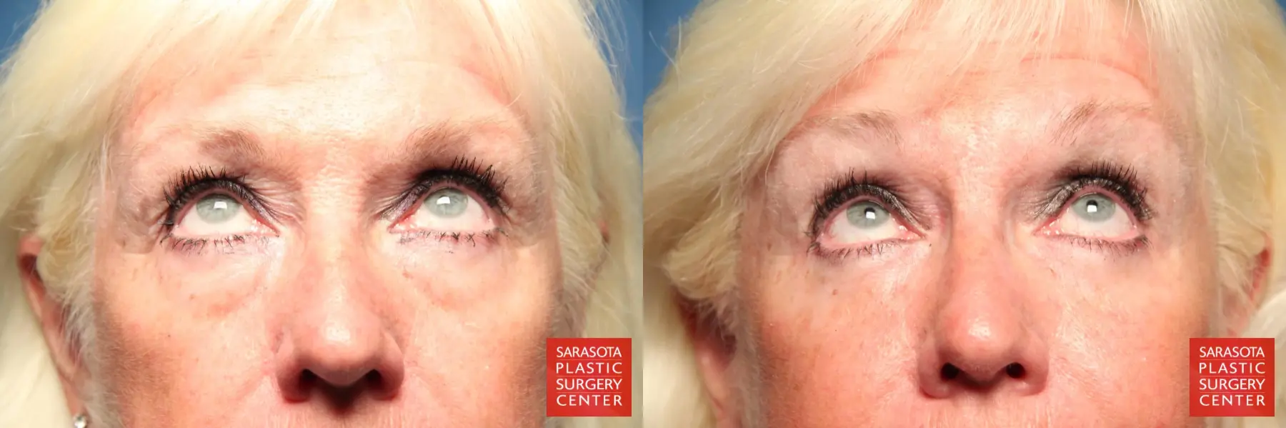 Eyelid Surgery: Patient 1 - Before and After 3