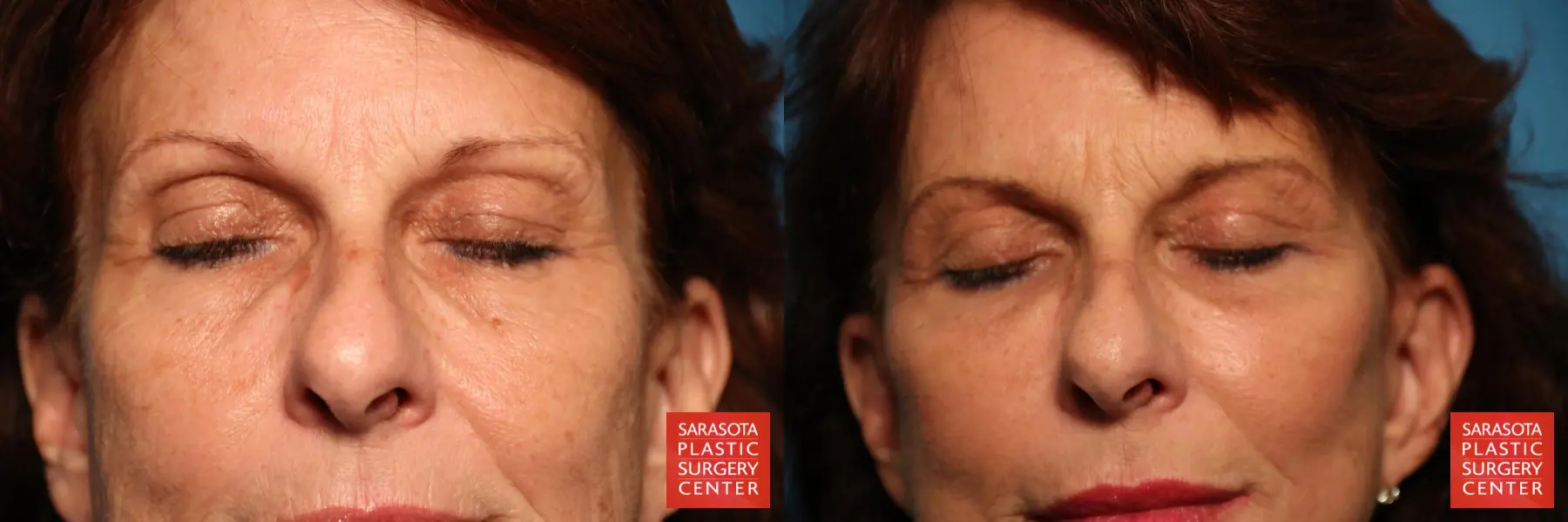 Eyelid Surgery: Patient 25 - Before and After 3