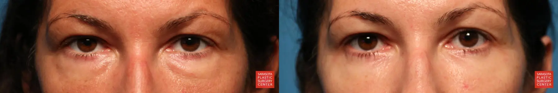 Eyelid Surgery: Patient 19 - Before and After  