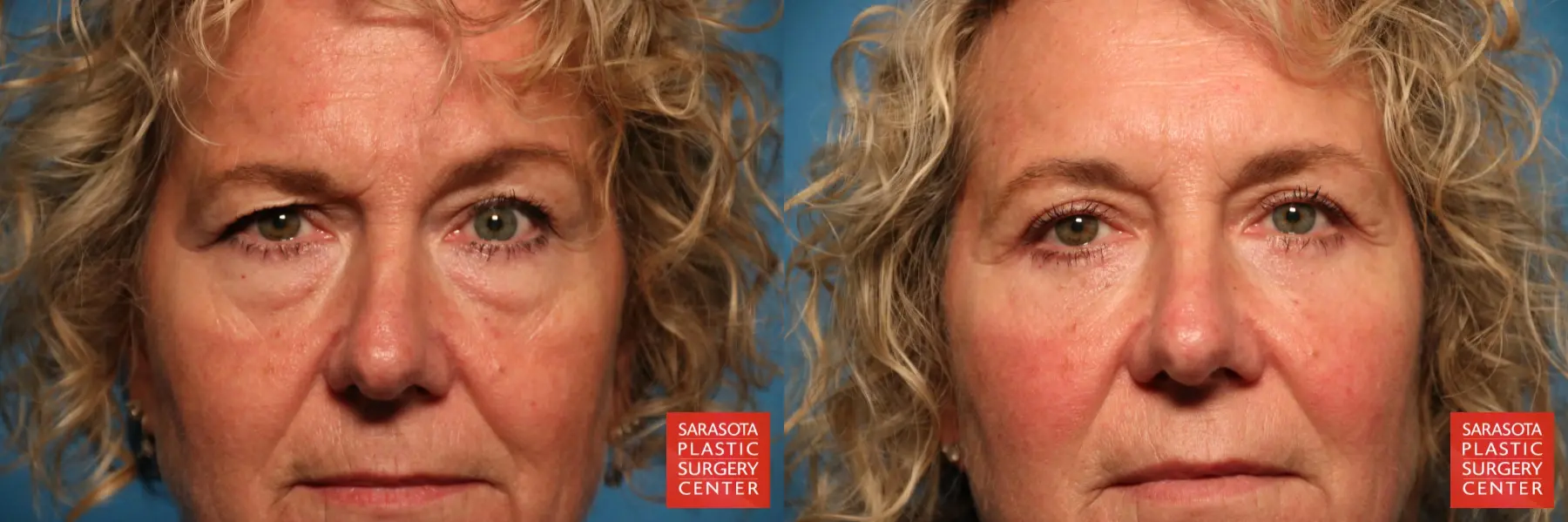 Eyelid Surgery: Patient 4 - Before and After  