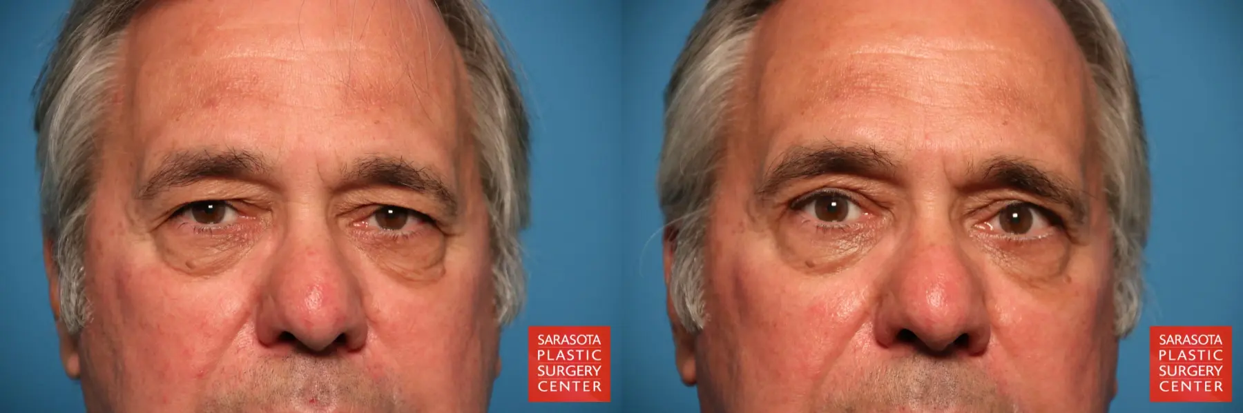 Eyelid Surgery: Patient 21 - Before and After  