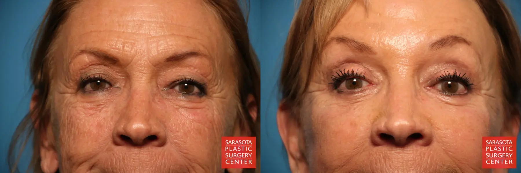 Eyelid Surgery: Patient 34 - Before and After  