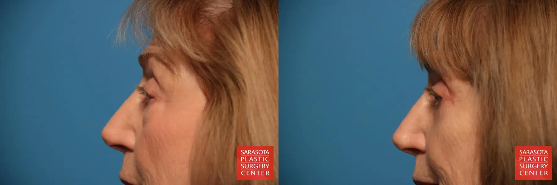 Eyelid Surgery: Patient 24 - Before and After 5